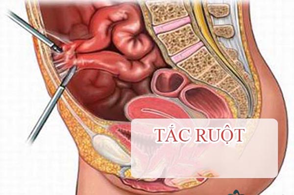 Tắc ruột