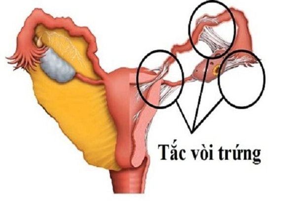 tac-voi-trung-co-kinh-nguyet-khong Tắc vòi trứng có kinh nguyệt không