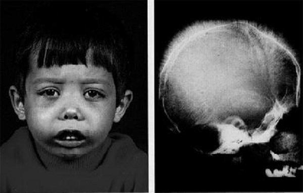 Tan máu bẩm sinh thalassemia