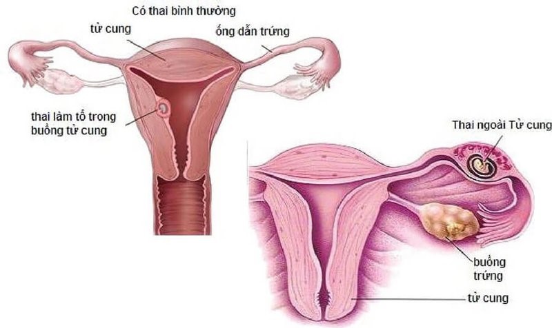 thai-ngoai-tu-cung-co-giu-duoc-khong thai ngoài tử cung có giữ được kữ được không
