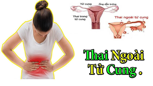 thai-ngoai-tu-cung-thu-que-hai-vach-khong Thai ngoài tử cung thử que hai vạch không