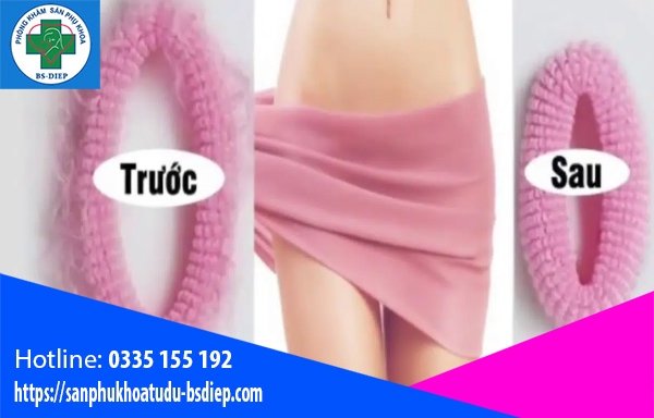 thu-hep-vung-kin-khi-nao Thu hẹp vùng kín khi nào