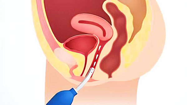 thut-rua-am-dao1 Thụt rửa âm đạp là cách làm sạch sâu âm đạo của phụ nữ
