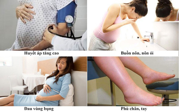 Triệu chứng tiền sản giật