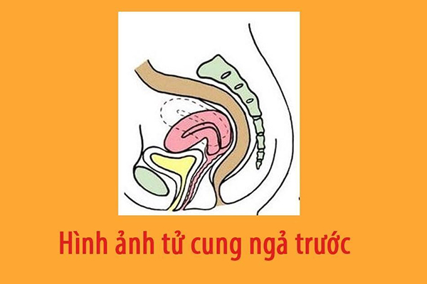 tu-cung-nga-truoc Hiện tượng tử cung ngả trước