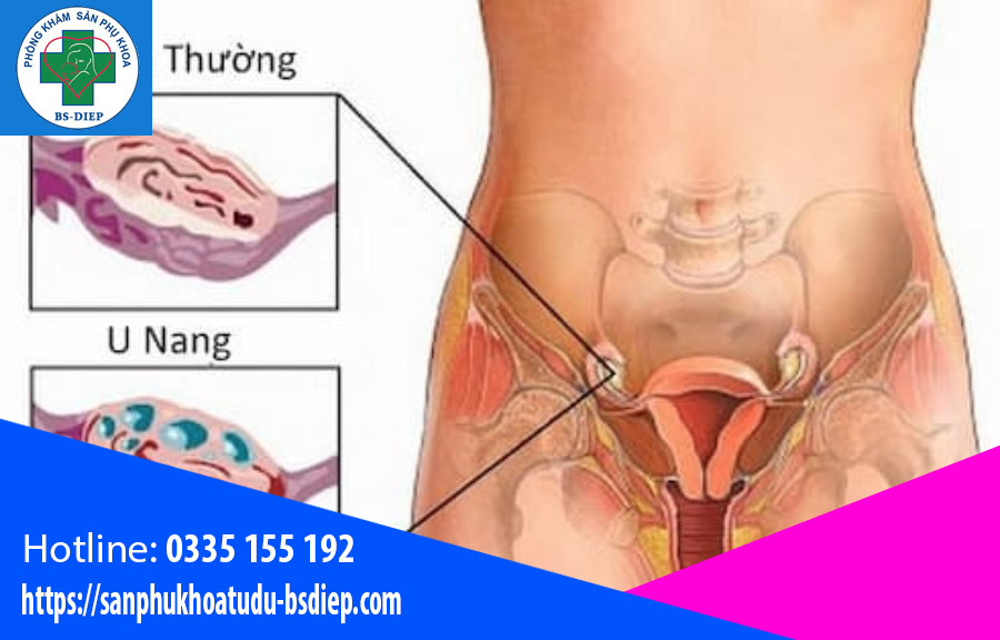 u-nang-buong-trung-nguy-hiem-khong U nang buồng trứng nguy hiểm không