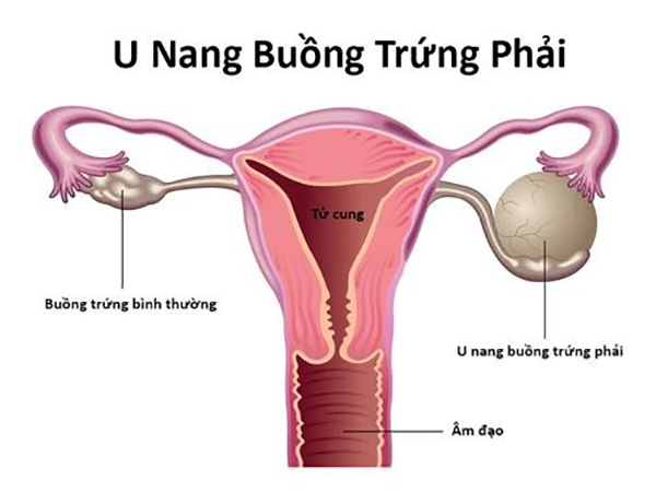 u-nang-buong-trung-phai-40mm Buồng trứng bên phải xuất hiện u nang 40mm