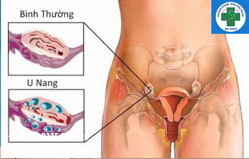 u-nang-buong-trung-trai-co-thai-duoc-khong U nang buồng trứng trái có mang thai được không
