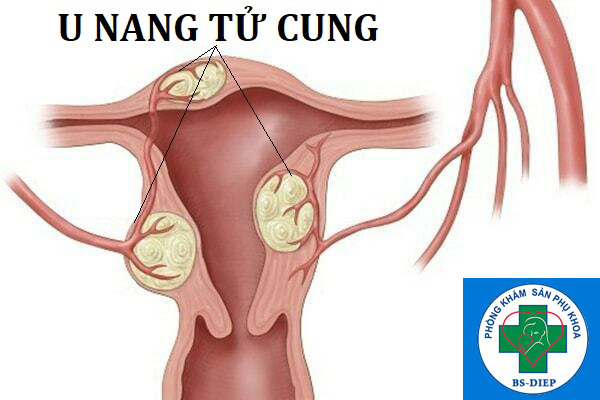 U nang tử cung