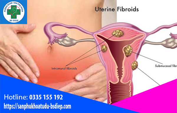 U xơ tử cung có nguy hiểm không