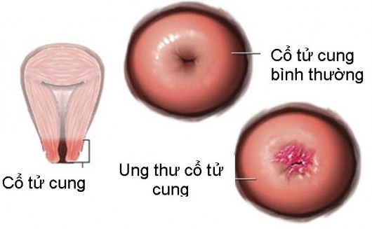 ung-thu-co-tu-cung-e1459324894433 Ung thư cổ tử cung