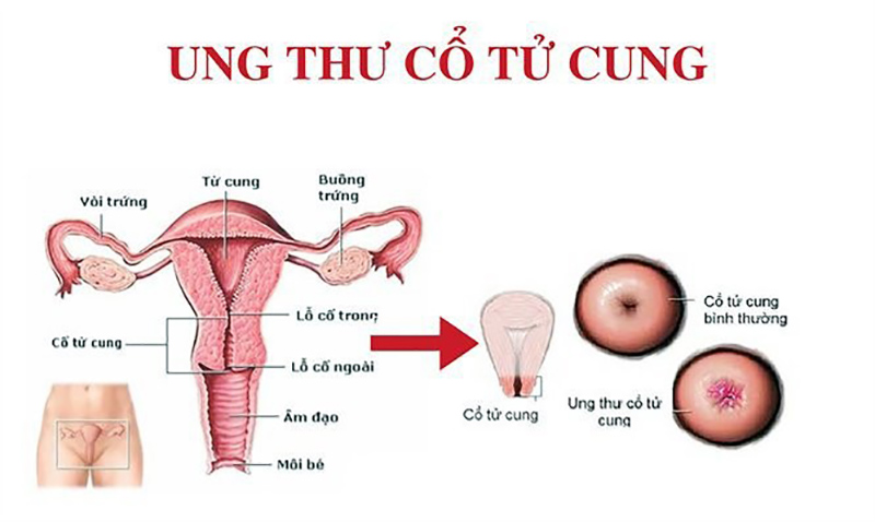 ung-thu-co-tu-cung Ung thư cổ tử cung