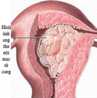 ung-thu-noi-mac-tu-cung-2-1 Các tế bào ung thư phát triển thành u ác tính