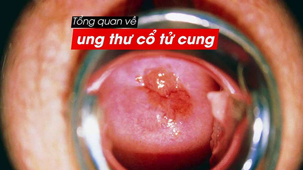 ung-thu-tu-cung Ung thư tử cung