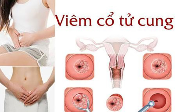 viem-co-tu-cung Viêm cổ tử cung