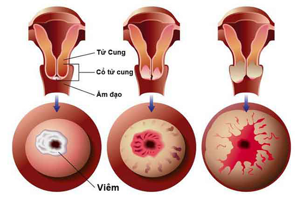 hình ảnh viêm lộ tuyến cổ tử cung