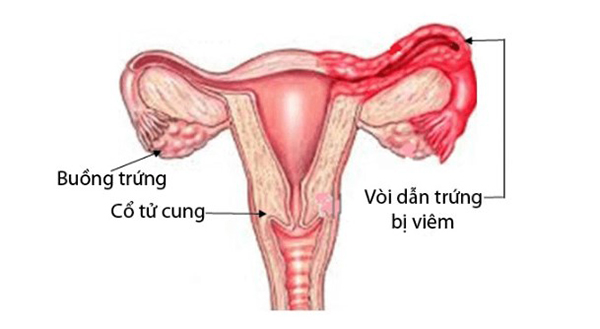 viem-voi-trung Viêm vòi trứng