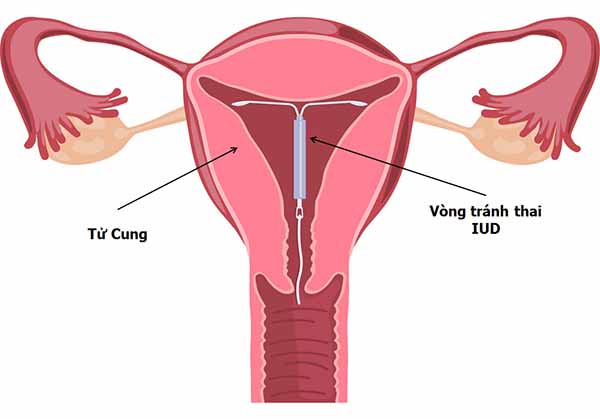 Vòng tránh thai trong cơ thể